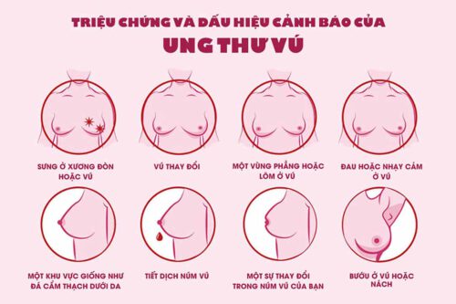 tư vấn về bệnh ung thư vú