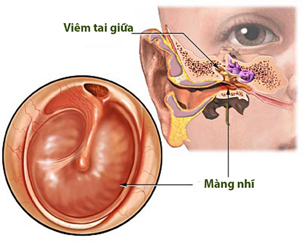 4 bệnh tai mũi họng phố biến mùa hè