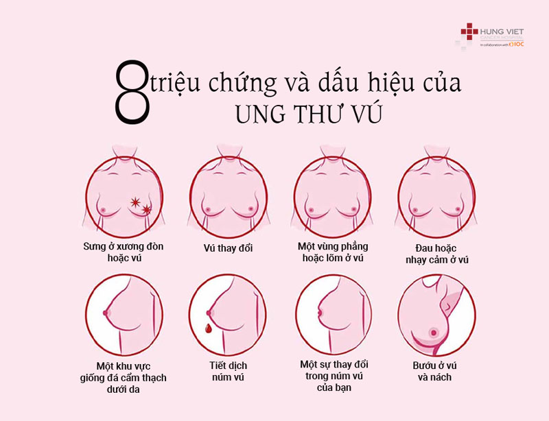 8 triệu chứng và dấu hiệu của ung thư vú