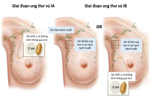 cac giai doan ung thu vu