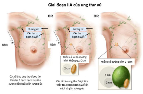cac giai doan ung thu vu