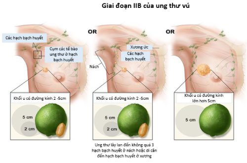 cac giai doan ung thu vu