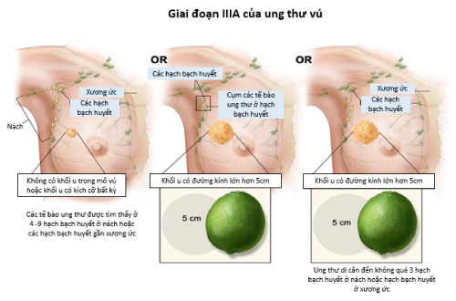 cac giai doan ung thu vu