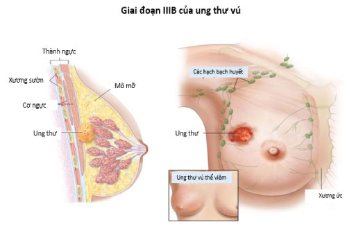 cac giai doan ung thu vu