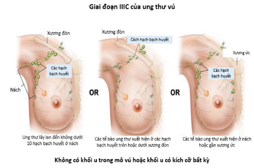 cac giai doan ung thu vu