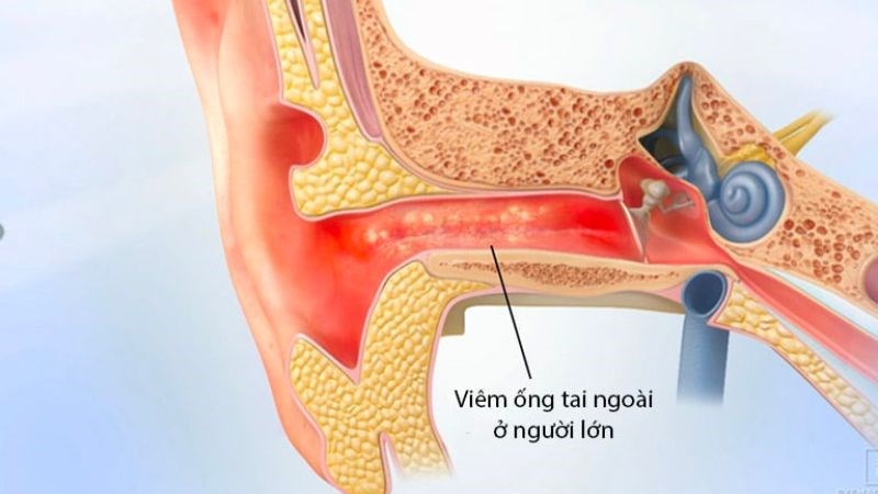 Viêm ống tai ngoài, nguyên nhân, dấu hiệu và phương pháp điều trị