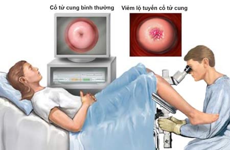 benh-viem-tuyen-lo-va-nguy-co-ung-thu-co-tu-cung