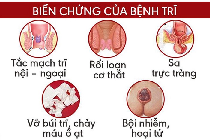 biến chứng bệnh trĩ