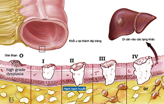 Phân độ ung thư đại tràng