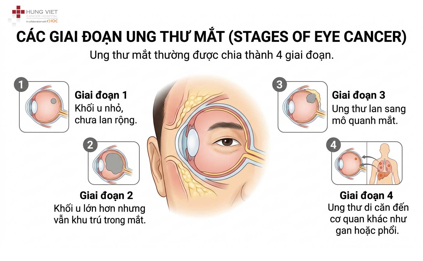 Các giai đoạn ung thư mắt