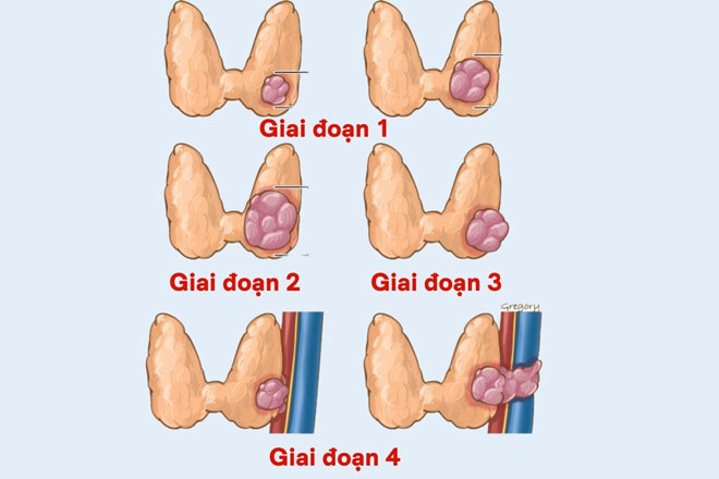 3. Triệu chứng của ung thư tuyến giáp giai đoạn 4