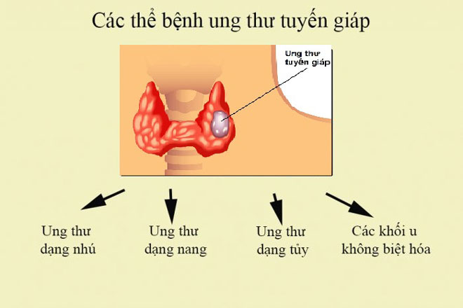 Tỷ lệ sống sót và dự đoán khả năng phục hồi của người mắc ung thư tuyến giáp thể nhú giai đoạn 2 là như thế nào?
