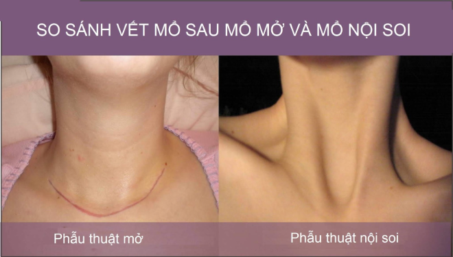 Mổ nội soi mang lại thẩm mỹ cao hơn mổ thường Mổ nội soi mang lại thẩm mỹ cao hơn mổ thường