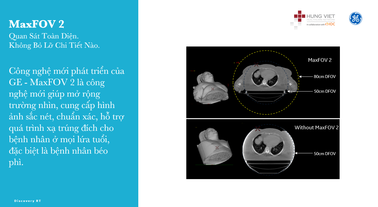 chụp CT phổi liều thấp