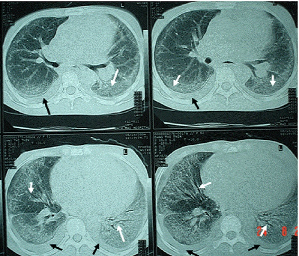 Hình ảnh chụp CT phổi