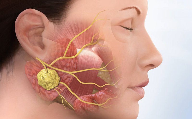 đau góc hàm dưới bên phải - bệnh lý tai mũi họng