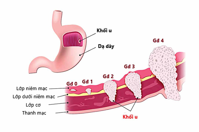 dấu hiệu ung thư dạ dày