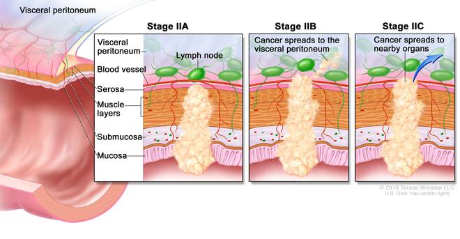 dấu hiệu ung thư đại tràng giai đoạn 2