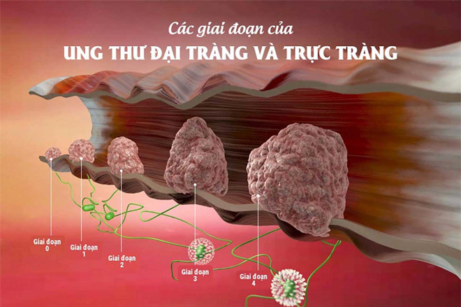 Dấu hiệu ung thư đại tràng giai đoạn cuối 