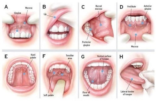Dấu hiệu ung thư khoang miệng
