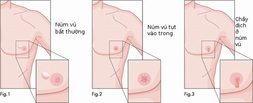 Dấu hiệu ung thư vú nam