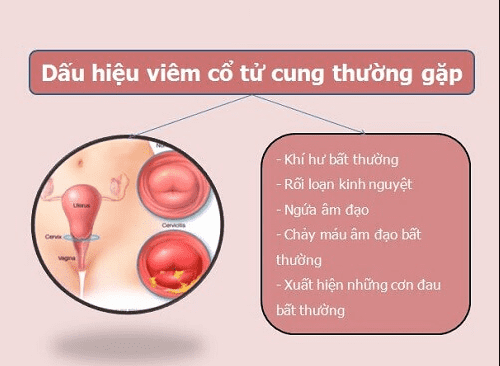 Phòng Ngừa Viêm Lộ Tuyến