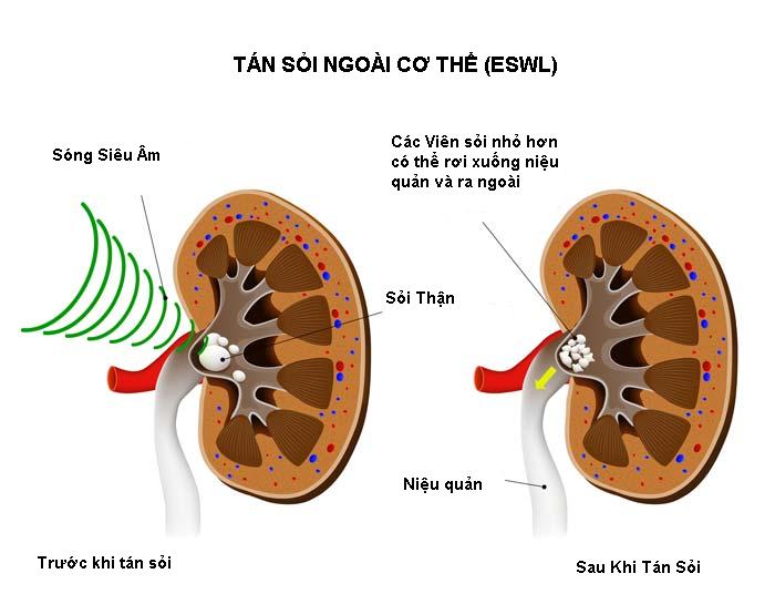 dieu-tri-soi-than-hieu-qua