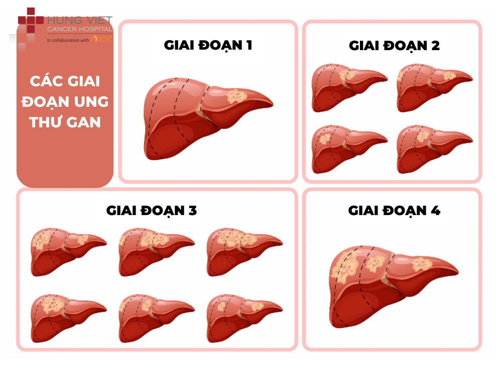 Giải đáp 6 câu hỏi thường gặp về ung thư gan
