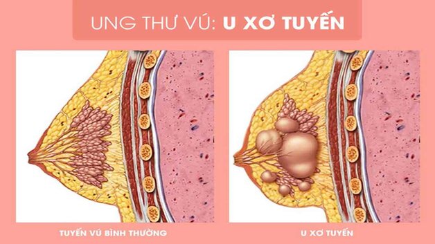 hình ảnh bệnh lý u xơ tuyến vú