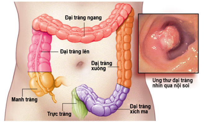 hình ảnh bệnh ung thư đại trực tràng