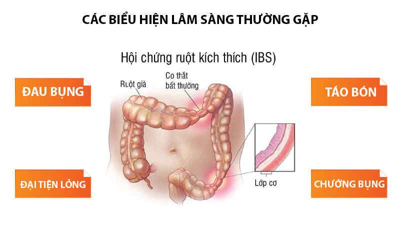 Hội chứng ruột kích thích: Nguyên nhân, dấu hiệu và cách điều trị hiệu quả