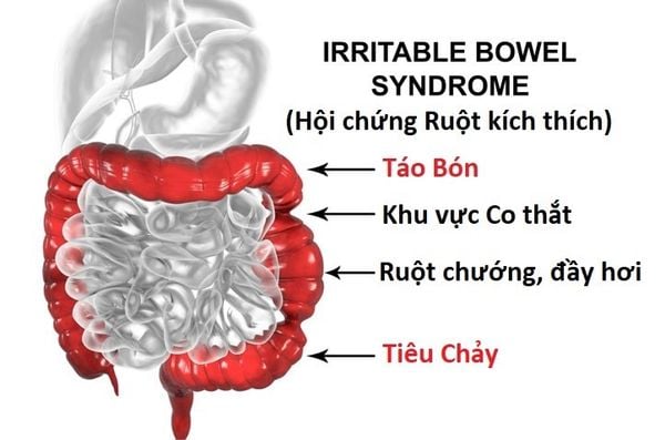 hội chứng ruột kích thích: nguyên nhân, dấu hiệu và cách điều trị hiệu quả