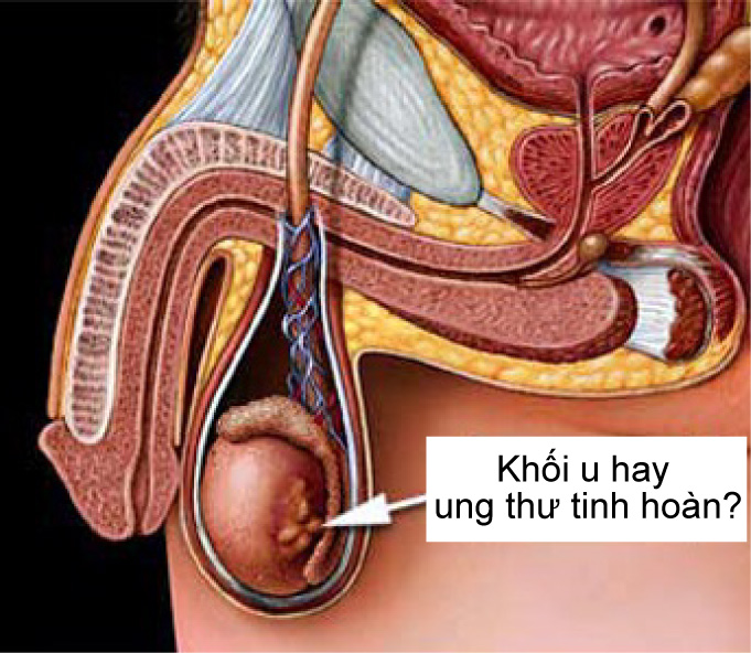 Chẩn đoán ung thư tinh hoàn