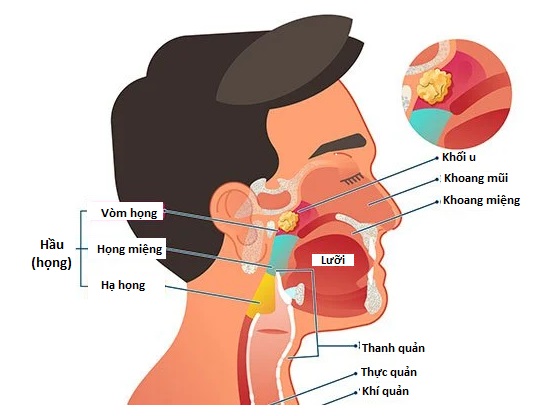 U nhú vòm họng lành tính có ảnh hưởng đến sức khỏe như thế nào? 
