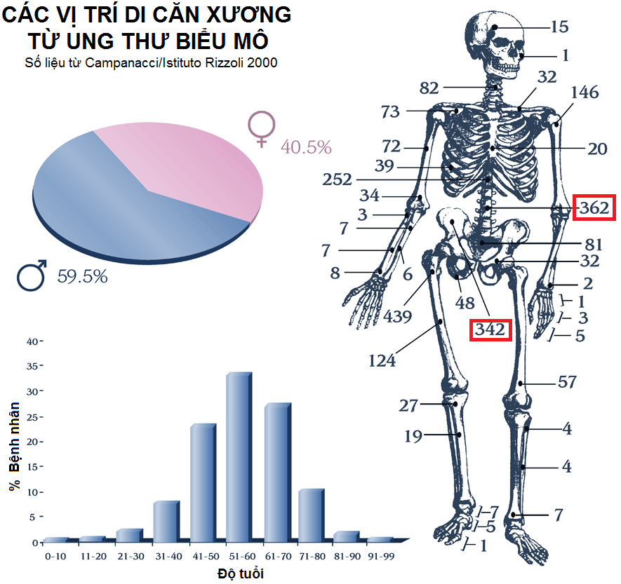 Vị trí ung thư di căn xương