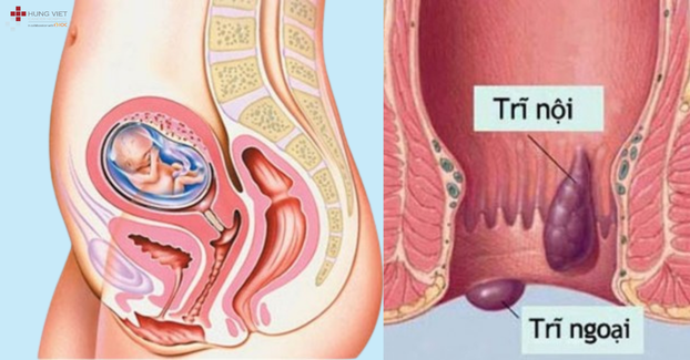 Mẹ bầu bị trĩ