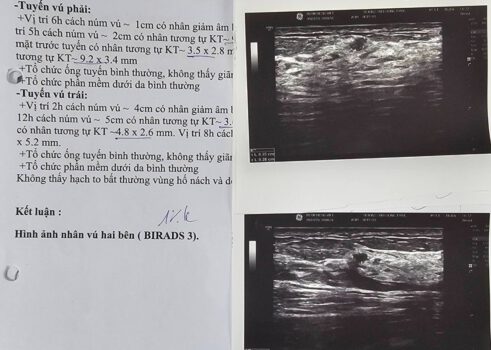 MỔ ĐA U XƠ VÚ (BIRADS 3) DƯỚI HƯỚNG DẪN SIÊU ÂM LÀ GÌ?