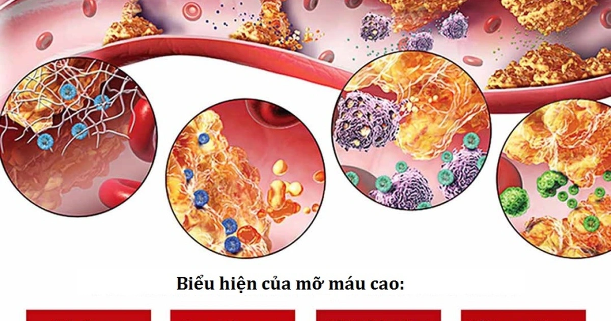 Mỡ máu và Ung thư: Cập nhật bằng chứng khoa học về vai trò của chuyển hóa lipid trong sinh ung và điều trị