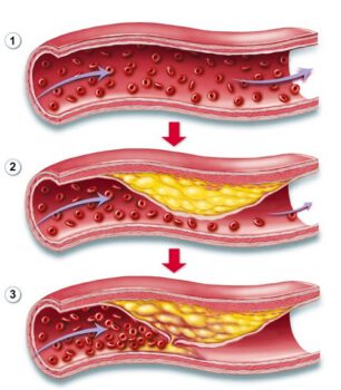 Mỡ máu và Ung thư: Cập nhật bằng chứng khoa học về vai trò của chuyển hóa lipid trong sinh ung và điều trị