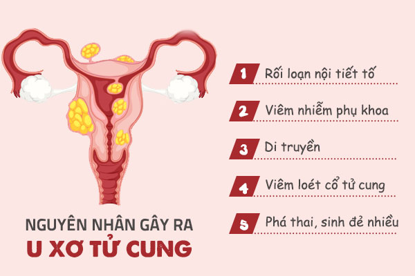 Nguyên nhân gây bệnh u xơ tử cung