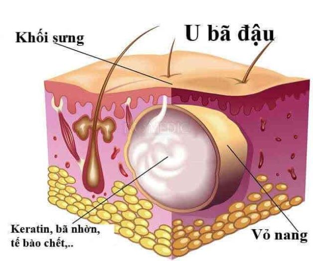 Cùng tìm hiểu về căn u ở mông và cách chăm sóc sức khỏe