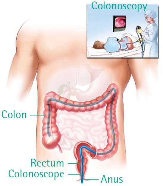 Nội soi đại trực tràng