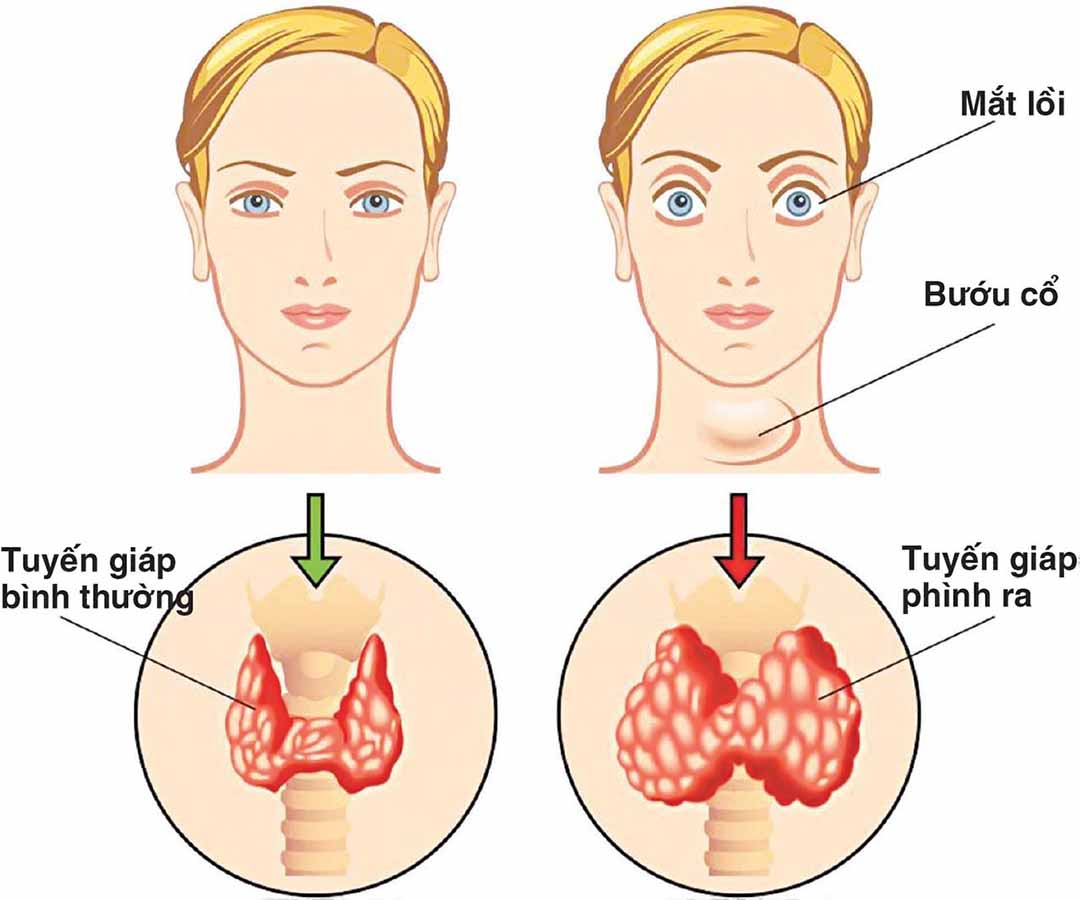[Tìm hiểu thêm] Phân biệt bệnh bazơđô với bệnh bướu cổ do thiếu iốt