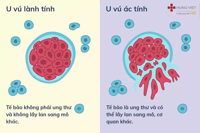 [tìm Hiểu Ngay] 10 Lầm Tưởng Phổ Biến Về Ung Thư Vú