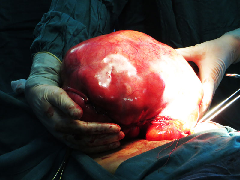 Khối u đường kính 30x35cm, khối lượng khoảng 8kg Khối u đường kính 30x35cm, khối lượng khoảng 8kg