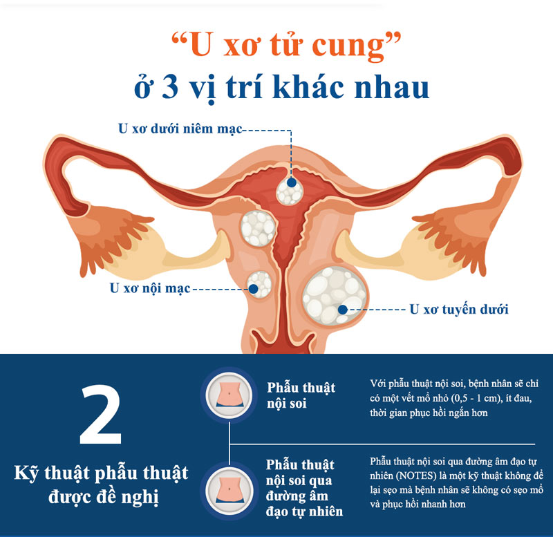 phẫu thuật u xơ tại tử cung