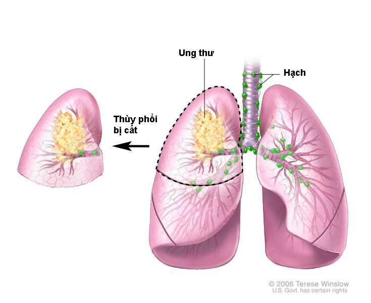 điều trị ung thu phổi