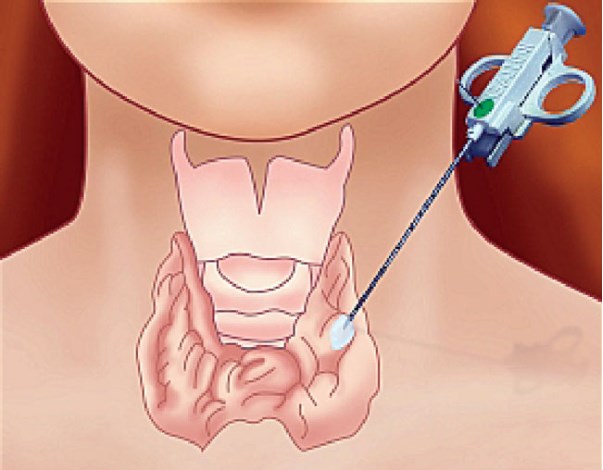 Hình ảnh sinh thiết tuyến giáp