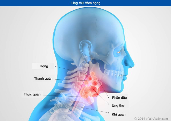 Tầm soát ung thư vòm họng sớm giúp phát hiện và điều trị bệnh ung thư vòm họng hiệu quả tầm soát ung thư vòm họng bao nhiêu tiền
