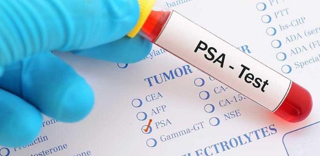 Chỉ số PSA trong tầm soát ung thư tiền liệt tuyến